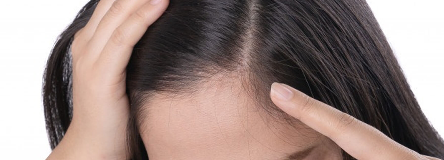 alopecia frontal fibrosante en canarias