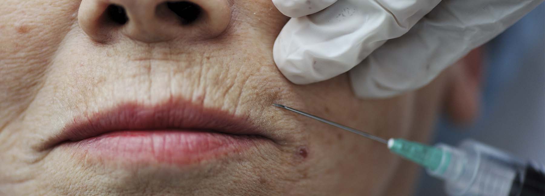 rejuvenecimiento facial con plasma rico en plaquetas en Las Palmas de Gran Canaria